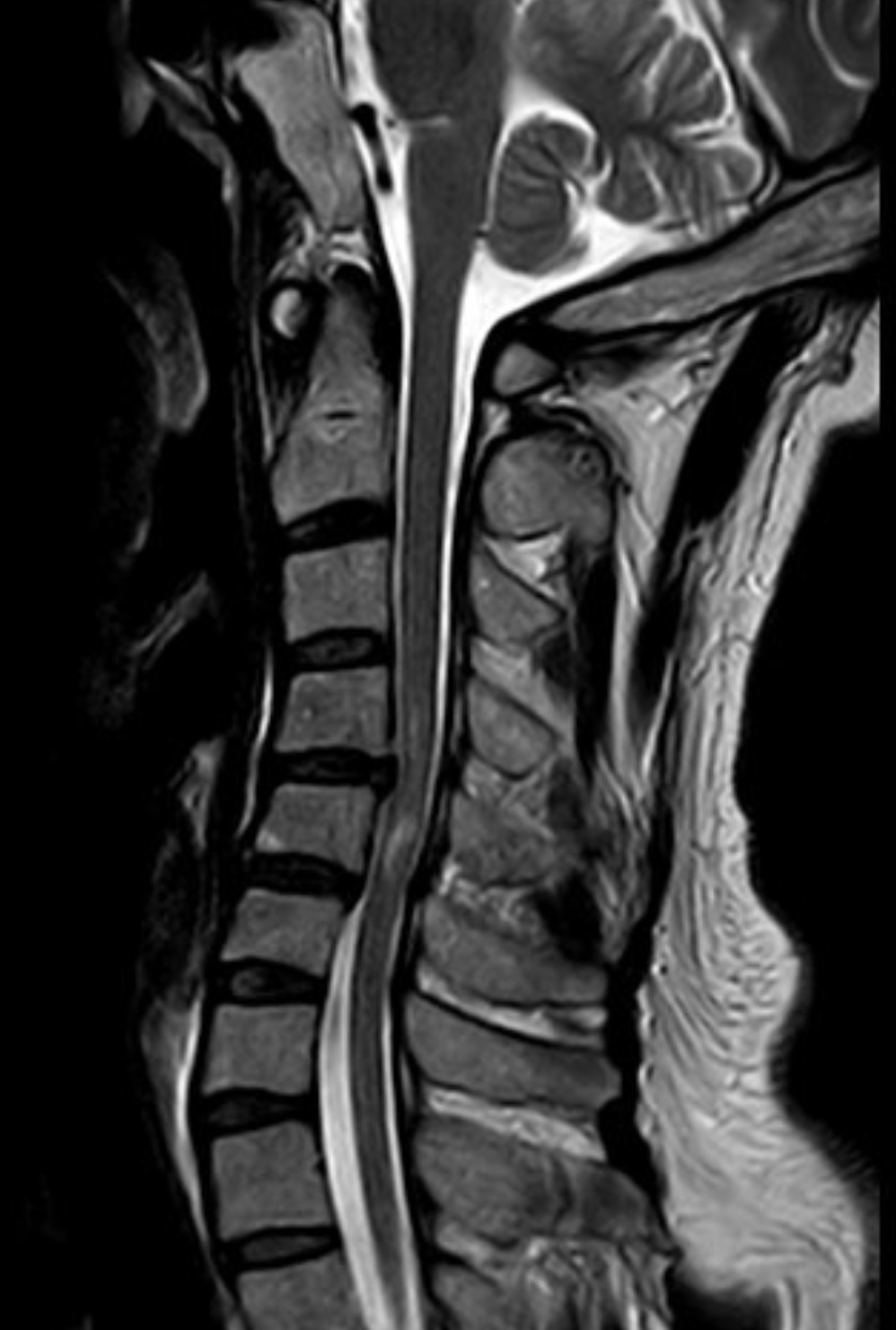 術前頸椎 MRI 顯示 C4/5、C5/6 椎間盤突出,合併脊髓壓迫與水腫